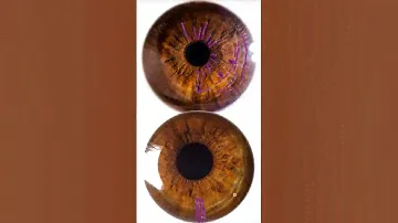 Through the Lens of Iridology - The True Brown Iris vs The Brown Iris